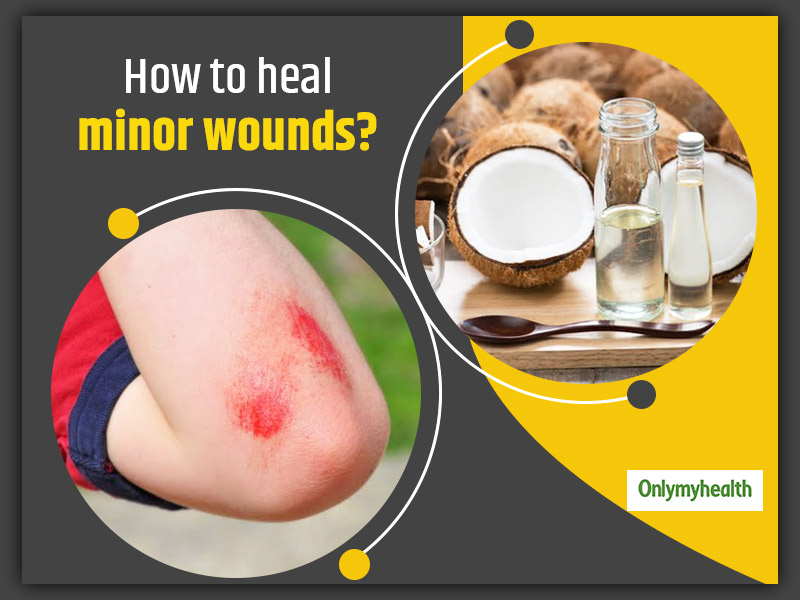 Here Are 10 Natural Remedies To Heal Minor Wounds